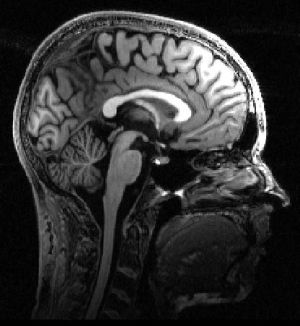 Eine MRT-Aufnahme von Marens Gehirn. 